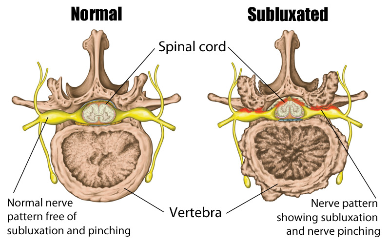 subluxation-illustration